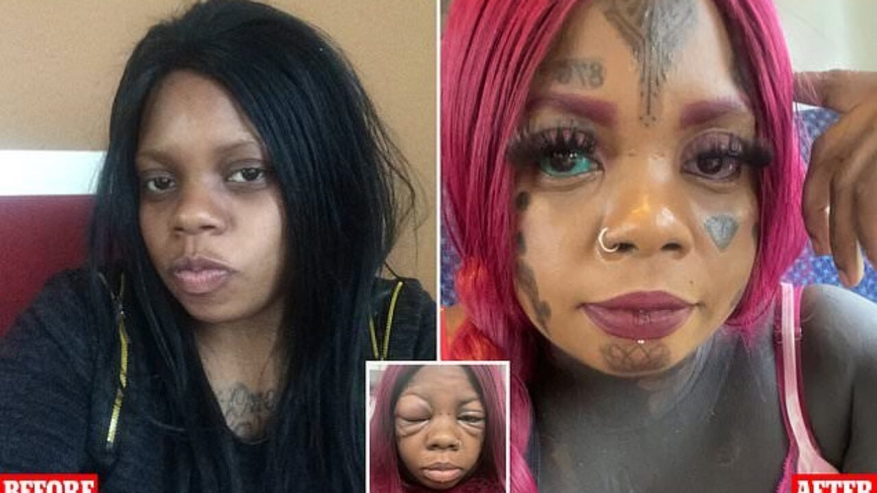 Woman going blind after getting her eyeballs tattooed blue and purple   Viral News Times Now