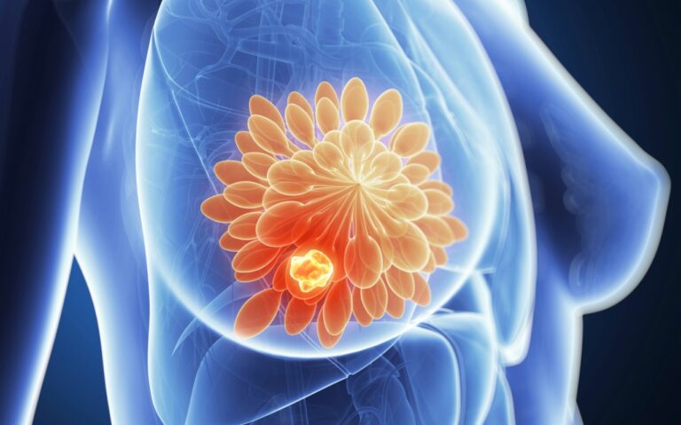 Breast cancer, Hibernating' Cells